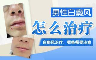 症状危害-白癜风的病发会出现哪些症状